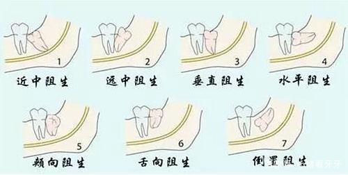 發(fā)炎的智齒什么時候拔才好？有些情況不能拔
