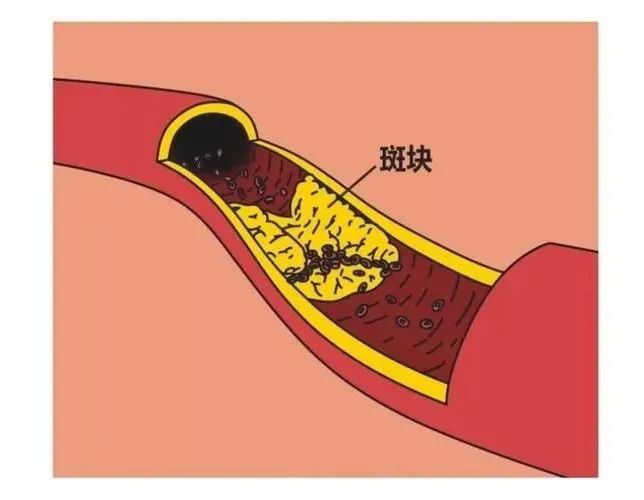 健康科普丨每個(gè)人都有動(dòng)脈斑塊？到底該怎么治療？