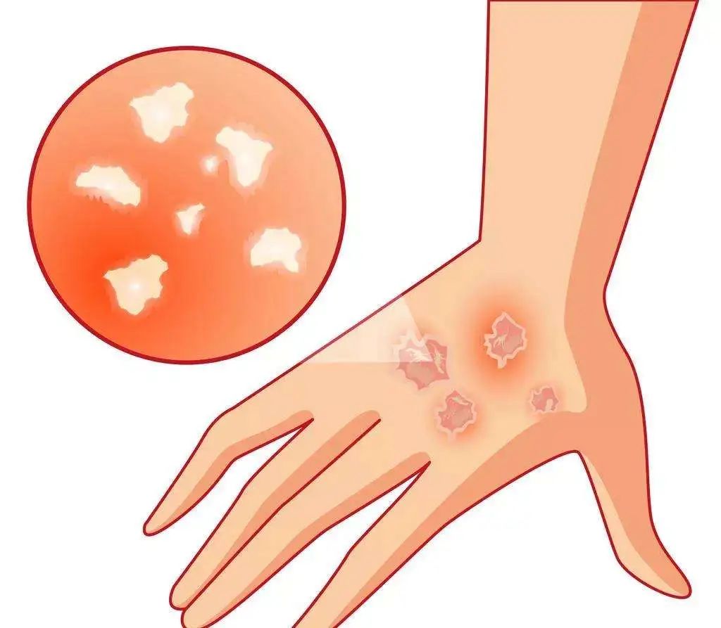 開在皮膚上的“花”？謹(jǐn)防春季玫瑰糠疹