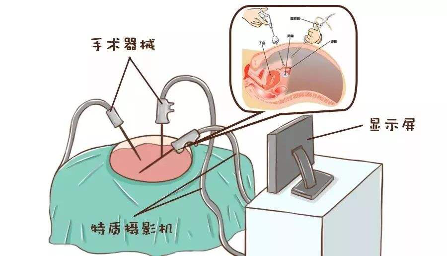 11歲女孩急性腹痛！竟然是卵巢囊腫蒂扭轉(zhuǎn)了