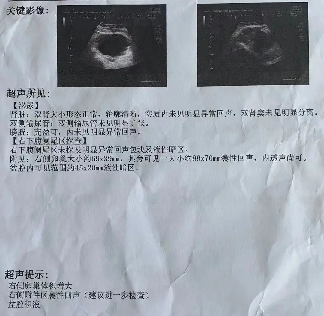 11歲女孩急性腹痛！竟然是卵巢囊腫蒂扭轉(zhuǎn)了
