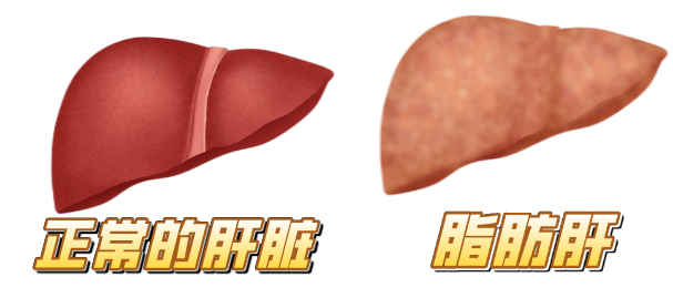 健康科普 從脂肪肝到肝癌的預防，這些肝臟疾病風險篩查一定要做哦！