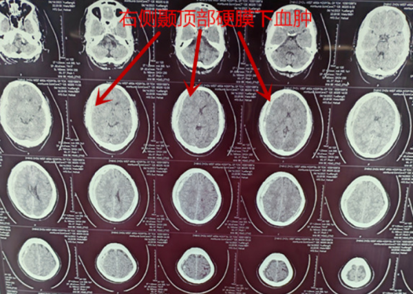 星夜拯救！神經(jīng)外科專家3小時接力，解除生命危機(jī)！
