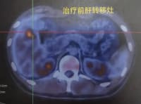 年輕小伙癌癥晚期！這些習慣不少人有，醫(yī)生：別忽視——