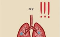 2 毫米肺結(jié)節(jié) 3 年后變肺癌！醫(yī)生提醒：這 2 種肺結(jié)節(jié)一定要當(dāng)心！