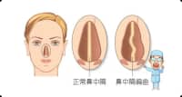 90%的人都患有鼻中隔偏曲，什么情況下需要手術？