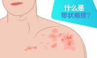 這種病不致命，疼起來卻要人命！關(guān)注帶狀皰疹，及早預(yù)防……