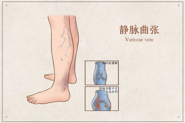 攝圖網(wǎng)_401799108_banner_靜脈曲張醫(yī)療插畫(企業(yè)商用).jpg 3-tuya.jpg