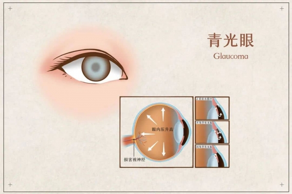 攝圖網(wǎng)_401804072_banner_青光眼醫(yī)療插畫(企業(yè)商用).jpg 1-tuya.jpg