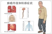 腿疼被診斷為肺癌晚期？腿上出現(xiàn)這4種現(xiàn)象，千萬要注意！