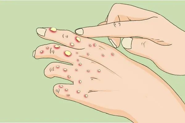 一到夏天手上就長出的“小水泡”到底是什么？了解清楚才能避免發(fā)作